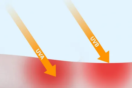 Gráfico quemaduras de sol en la piel