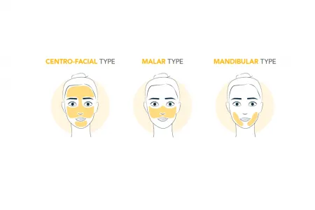 El melasma es una forma de hiperpigmentación que aparece de forma simétrica en el rostro. Esta afección produce manchas a ambos lados de la cara como por ejemplo debajo de la nariz, en el mentón y a lo largo de la frente. Su desaparición y reaparición están relacionadas con el tiempo de exposición al sol y la estación del año.